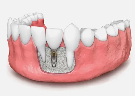 Dental Implants - Triple A Dental Clinic